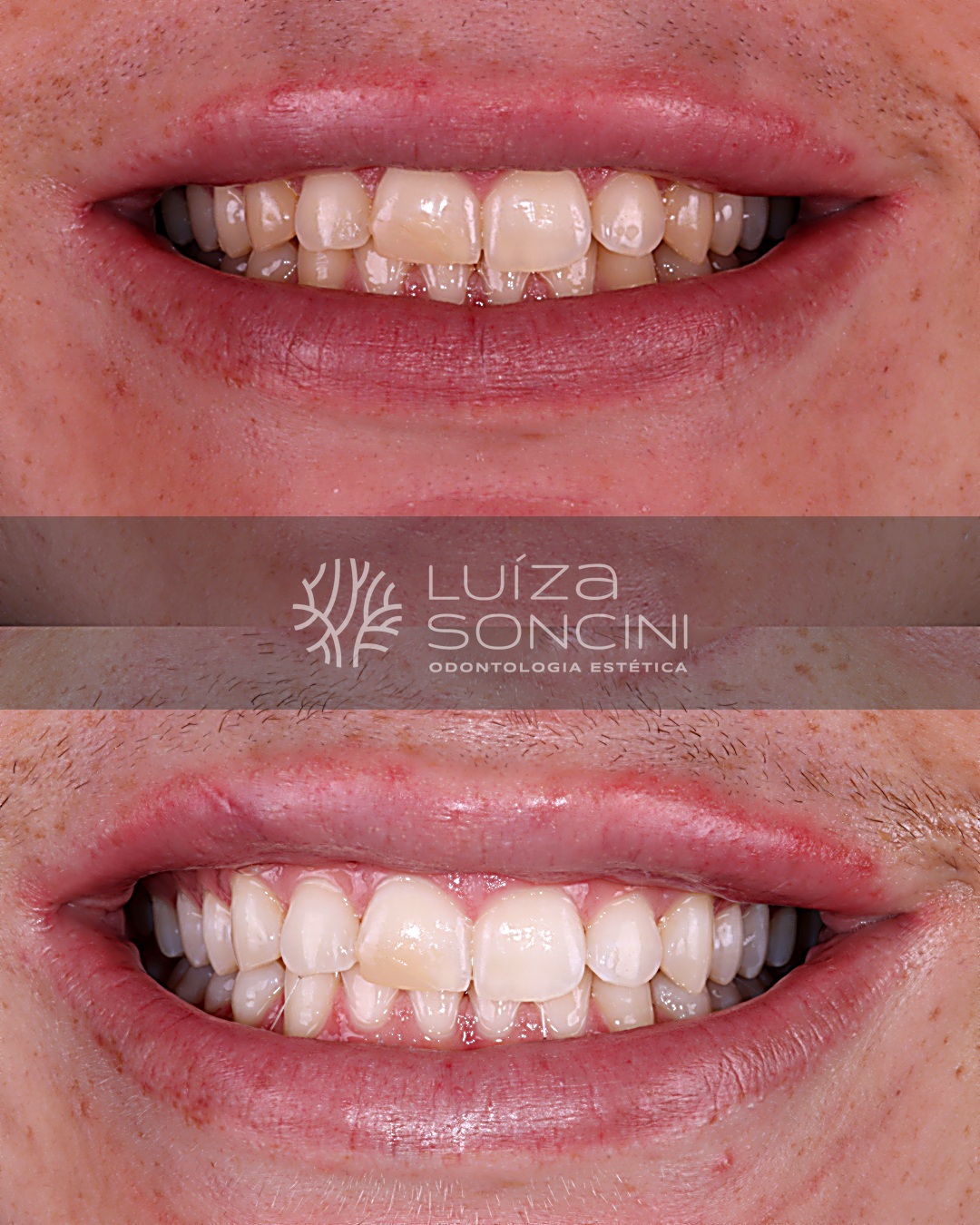 Caso antes e depois