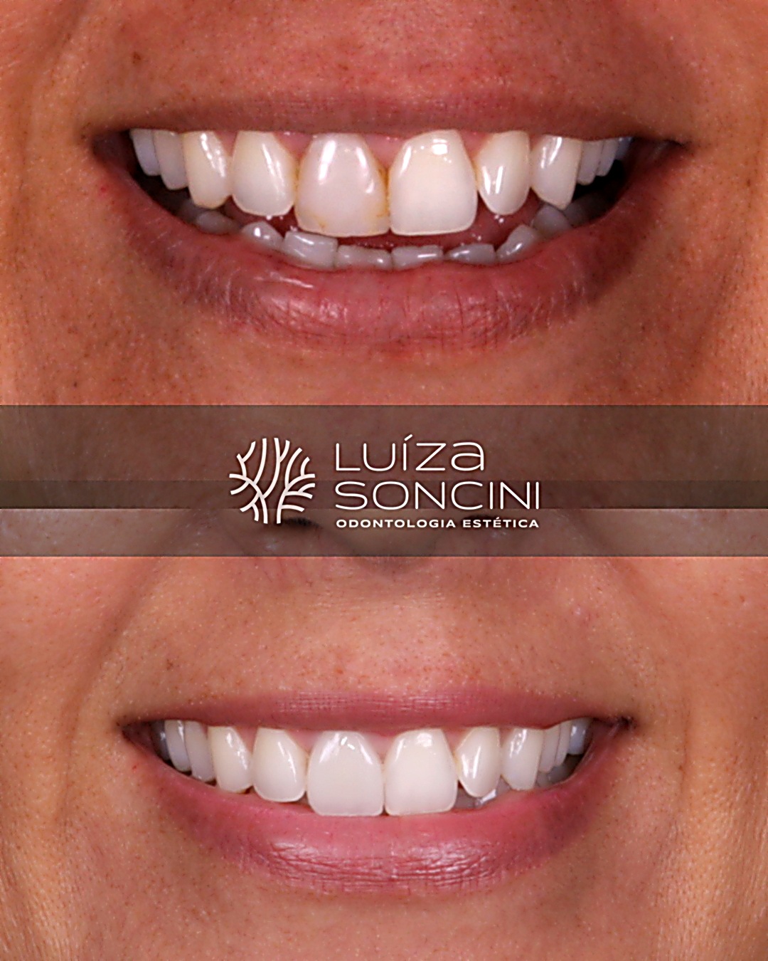 Caso antes e depois