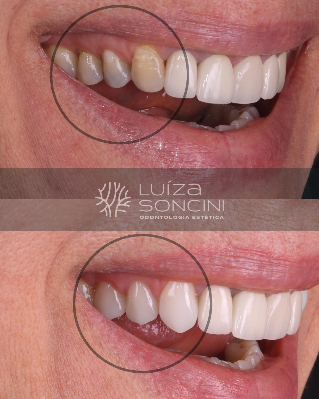 Caso antes e depois