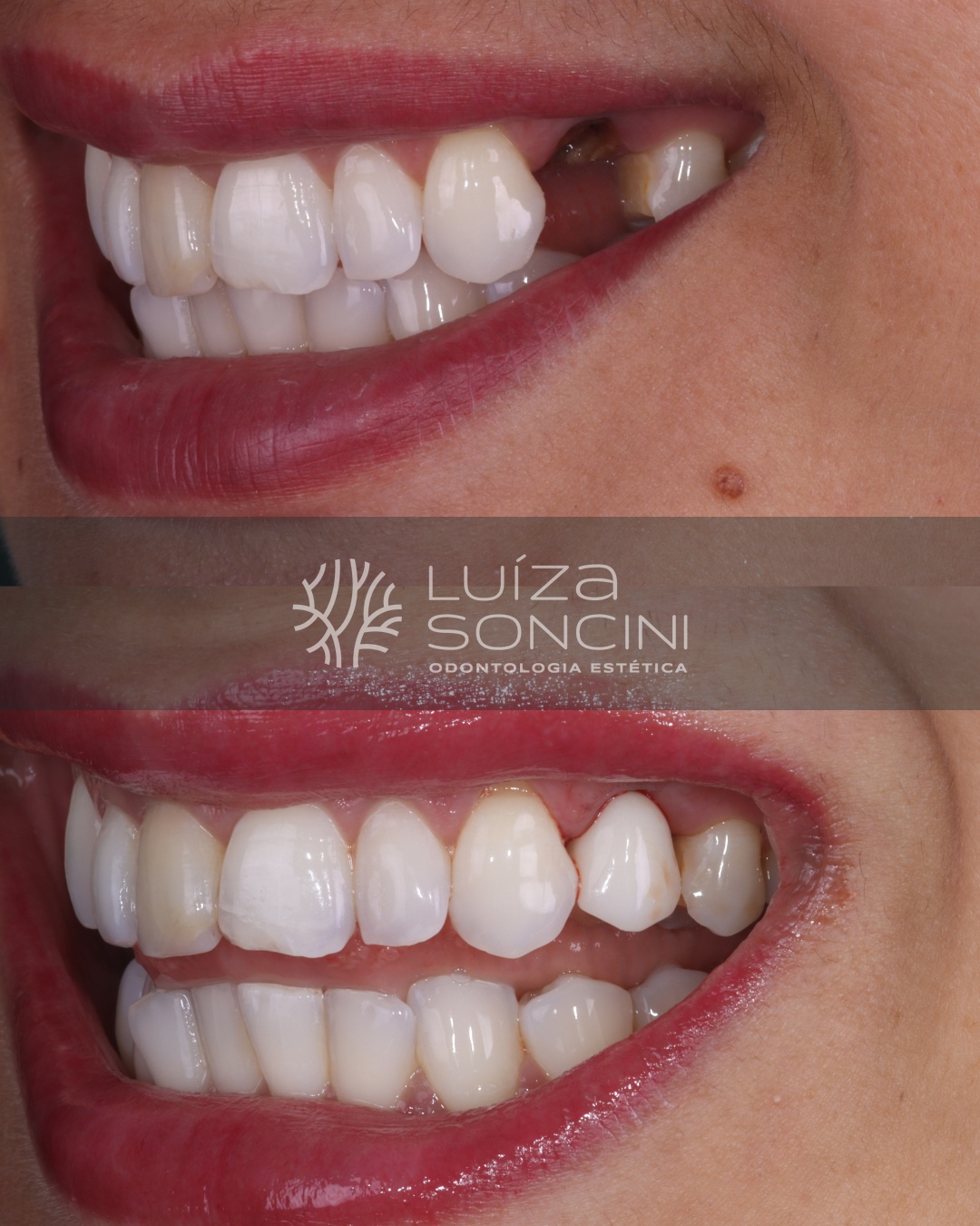 Caso antes e depois
