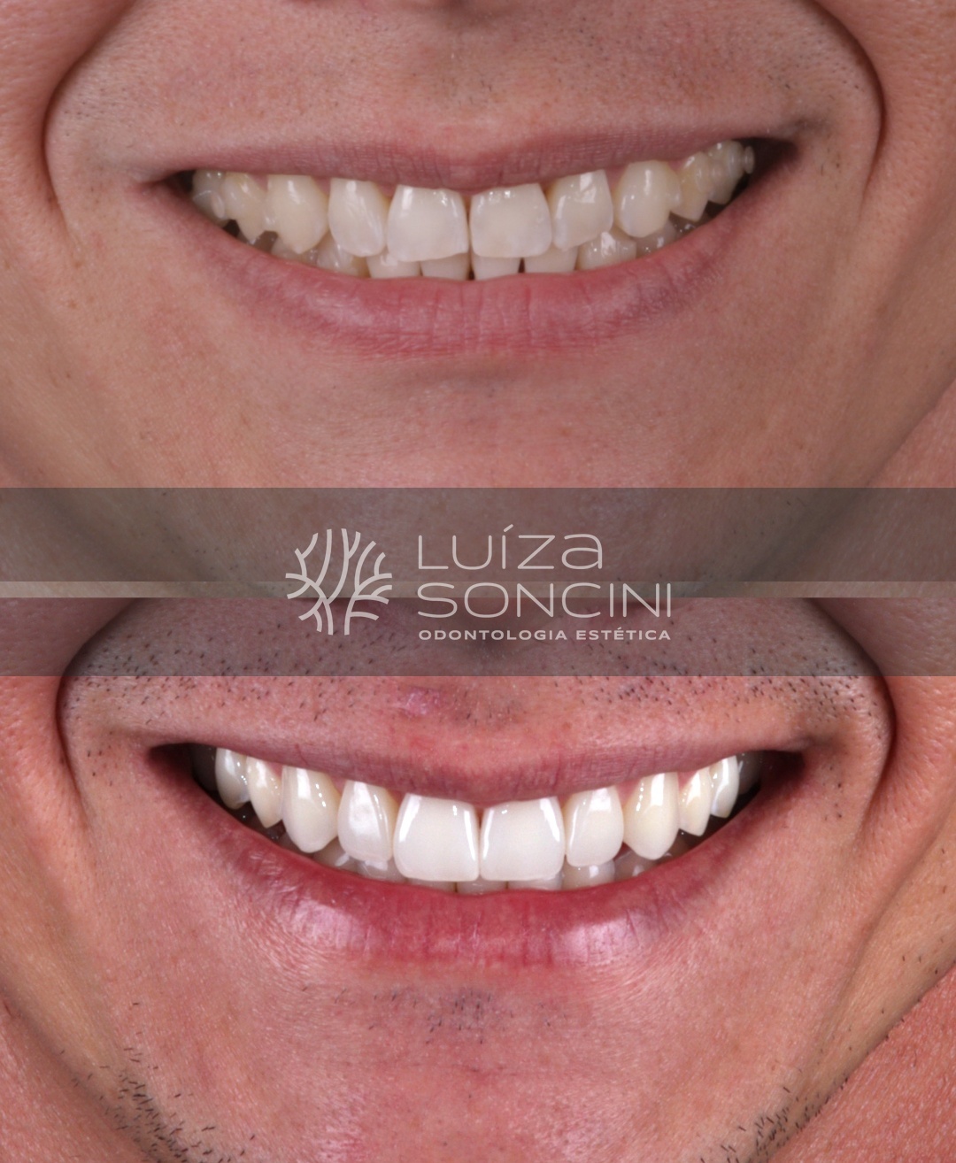 Caso de lentes de contato dental