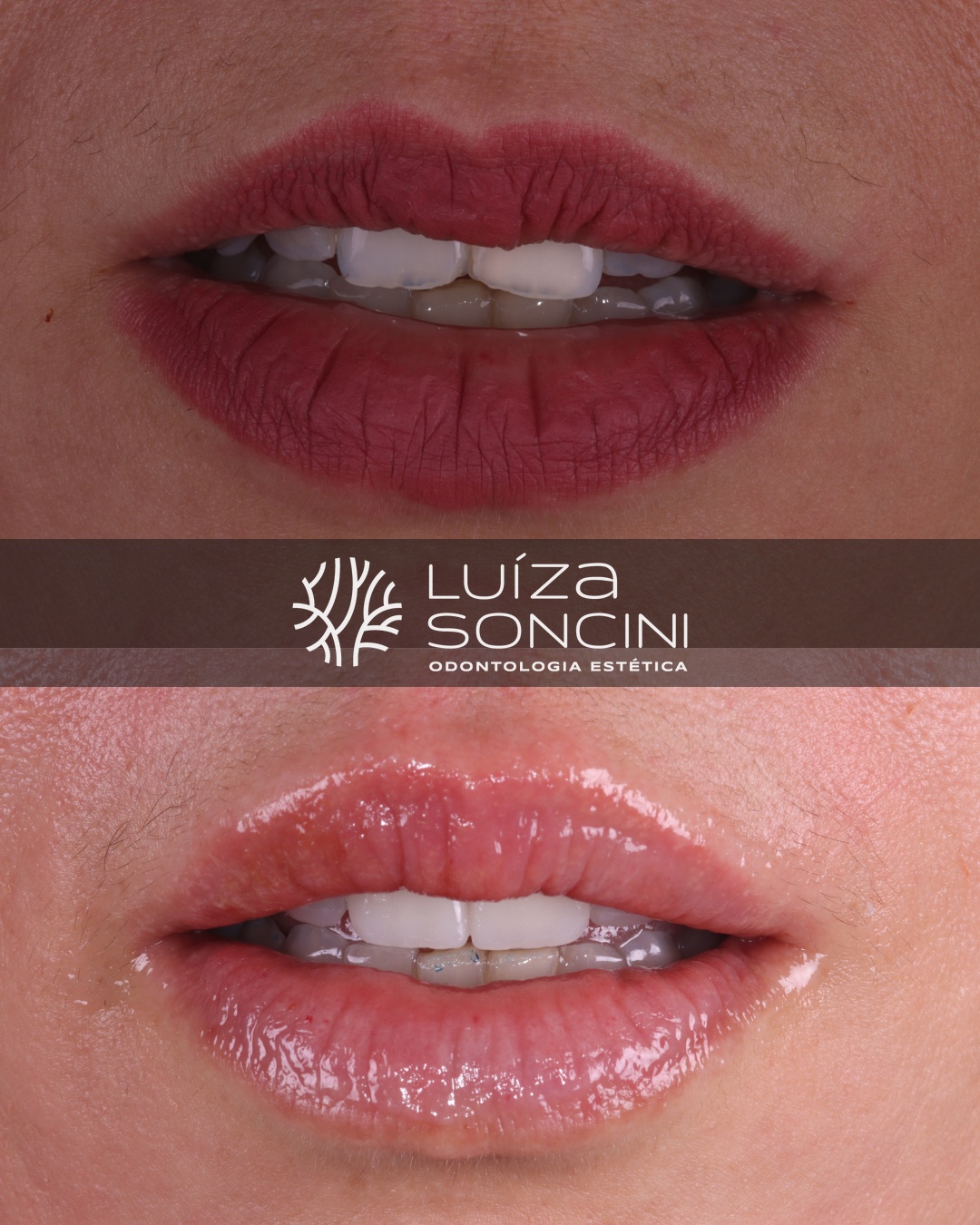 Caso antes e depois
