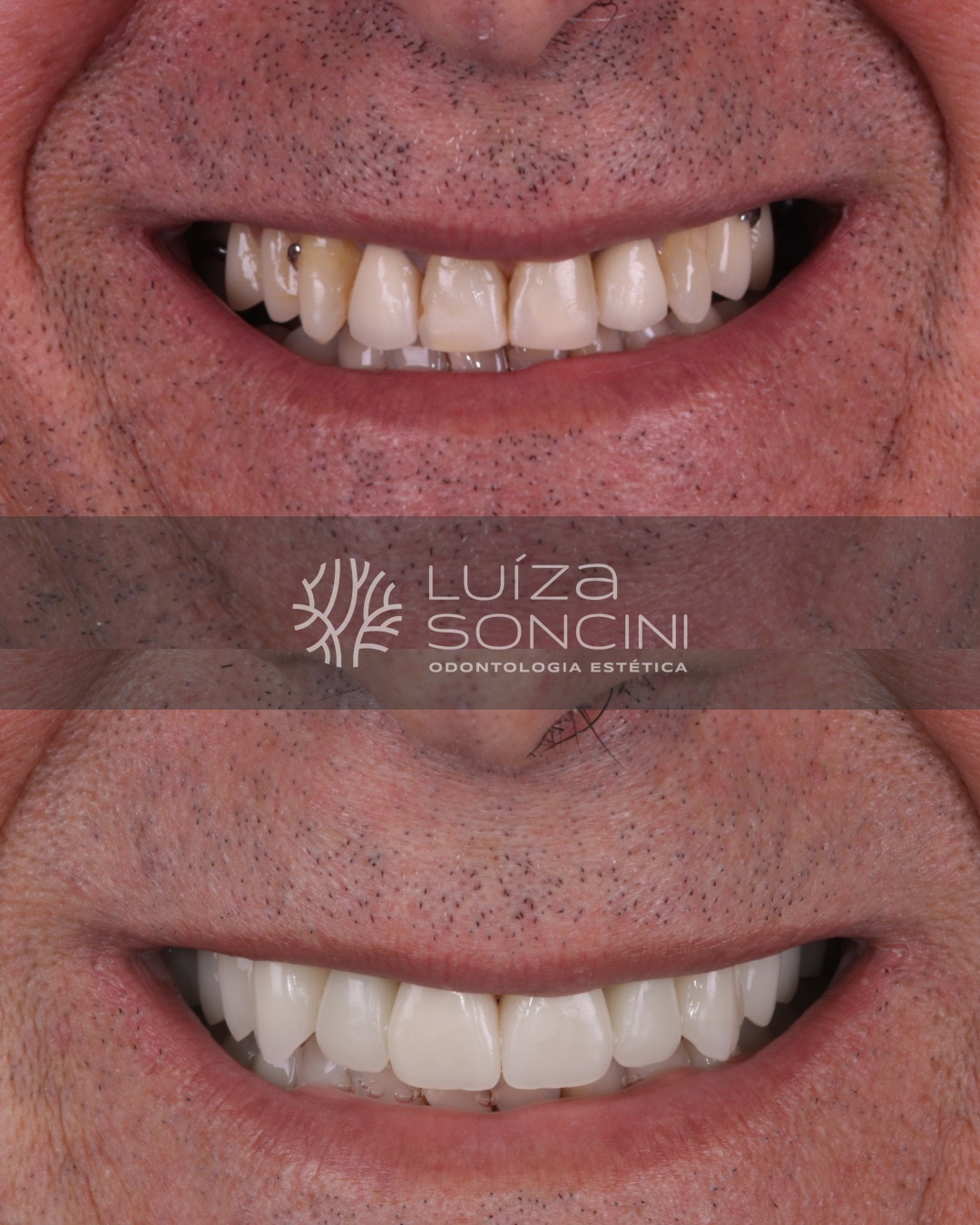 Caso antes e depois
