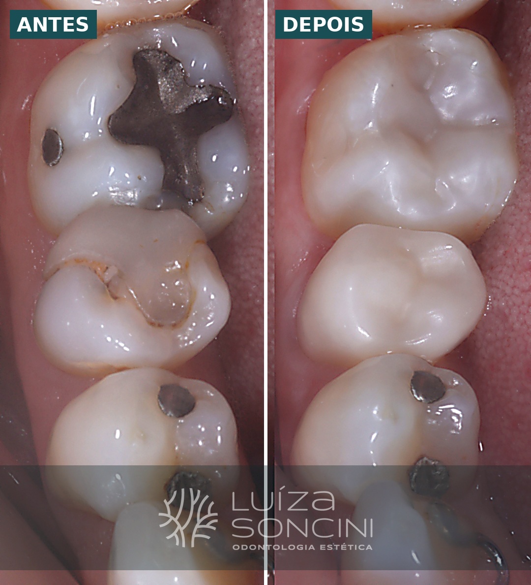 Caso antes e depois